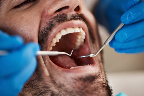 Best Dental Fillings (Composite and Amalgam)  in USA